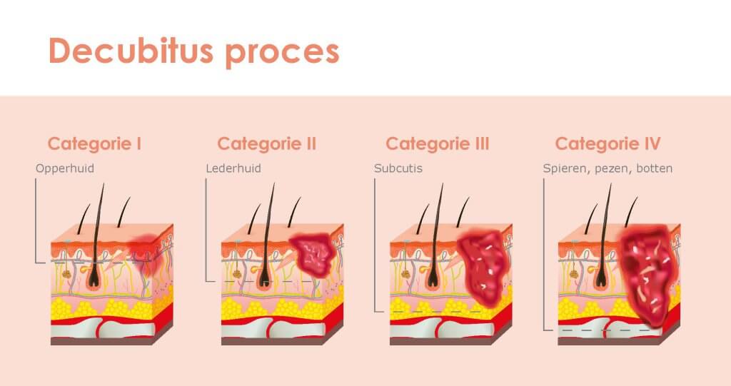 Classificatie voor decubitus en doorligwonden