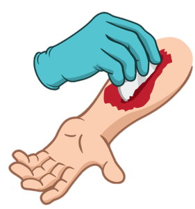 Acute bloeding - gaas in wond