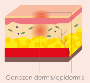 Hermodellerings fase van het wondgenezingsproces